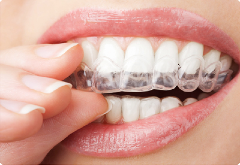 Translucent Cosmetic Braces  Greater Vancouver Orthodontics